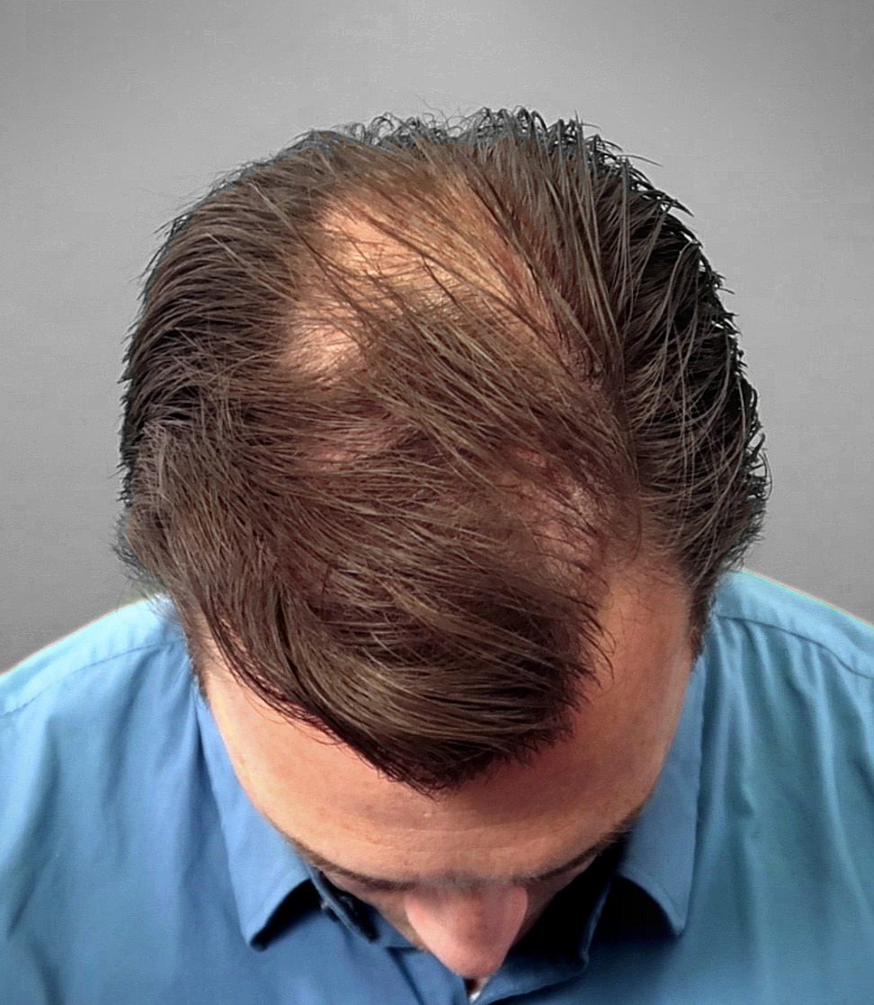 Man with thinning hair.